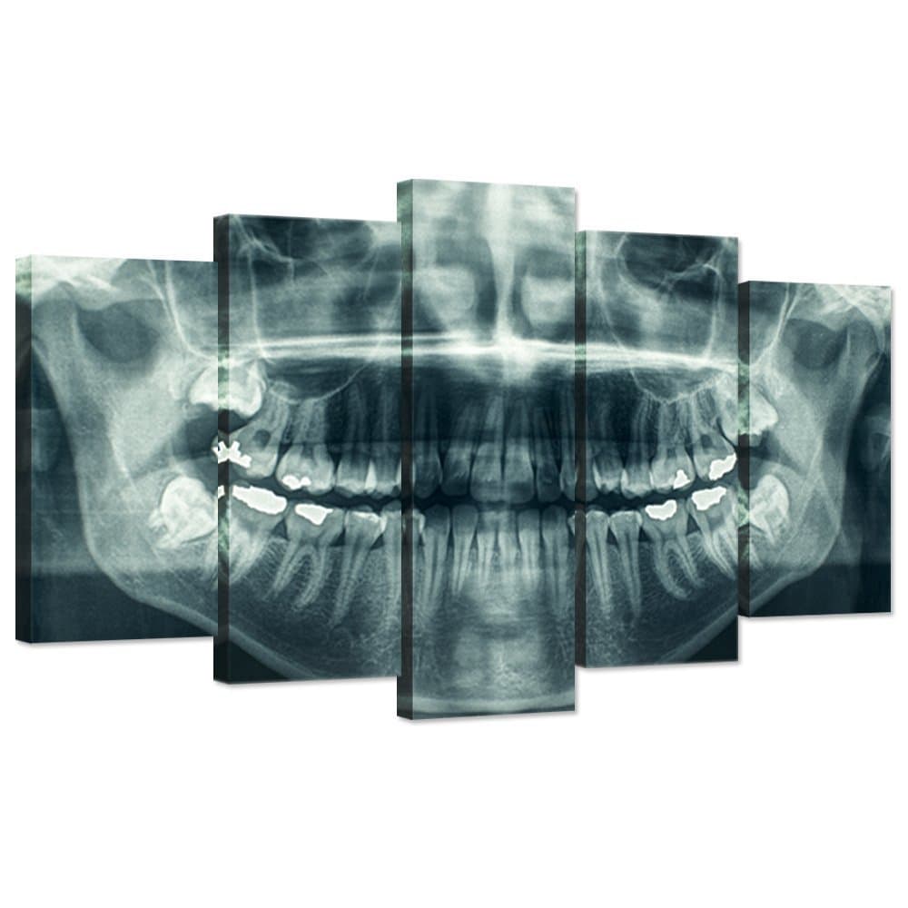 Modern 5 Panel Canvas Wall Art X-Ray Dental Tooth Oral Panoramic The Picture Teeth Decay Print for Dental Room Stretched And Framed For Living Room Ready To Hang